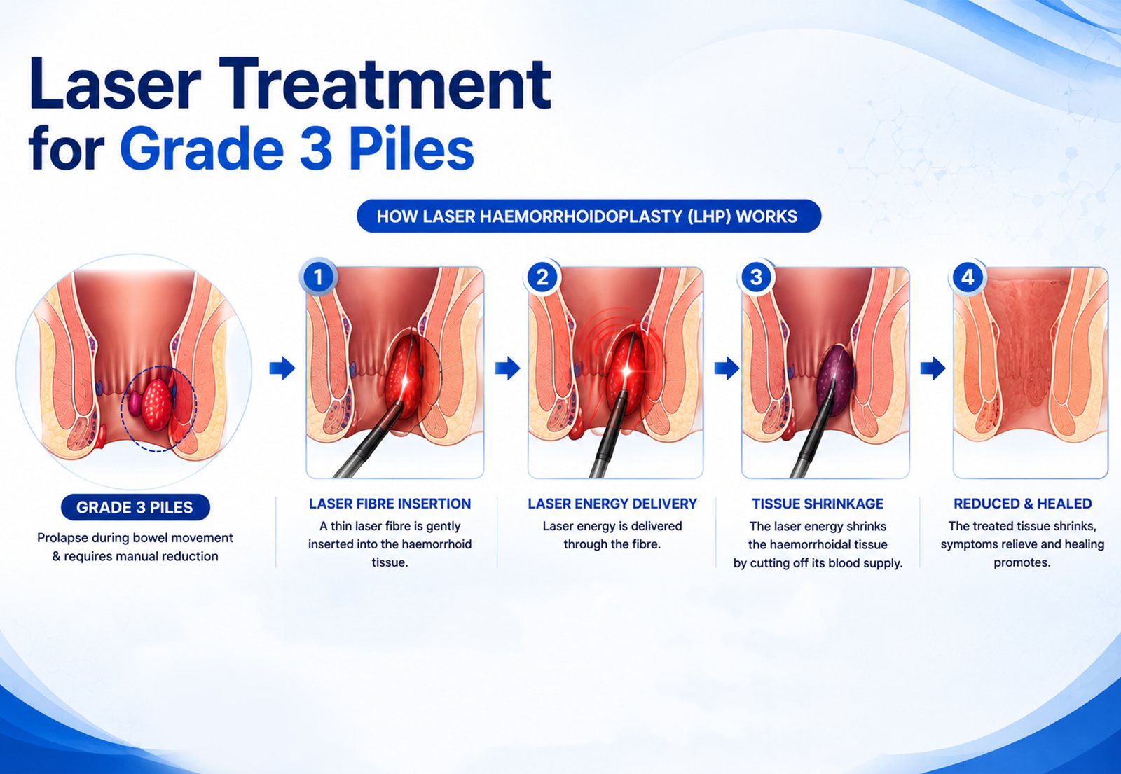 Medical infographic explaining Grade 1, Grade 2, Grade 3 and Grade 4 piles
